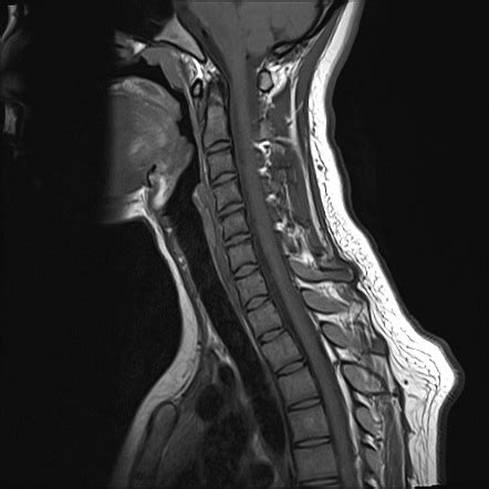 Normal MRI Cervical Spine Radiology Case Radiopaedia Org