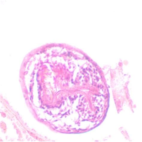 Histopathological Specimen Of Hydatid Cysts The Scolex Contained