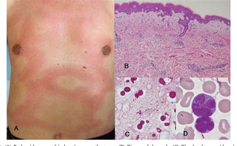 Figure 1 From Reactive Erythema Secondary To Adult T Cell Leukemia And