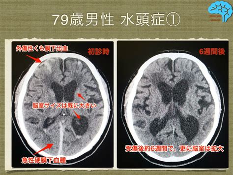 Mousou kanshou daishou renmeisimplified chinese: 79歳男性、続発性正常圧水頭症の改善例｡無症候性の脳室拡大で ...