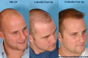 Temporal Point Restoration Photos Hair Transplant Artistry Bauman