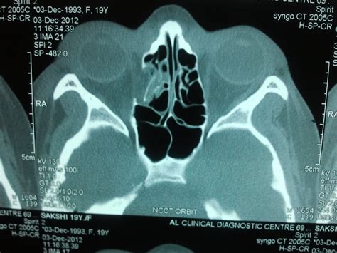 Ent Surgeons Blog Isolated Fracture Of Lamina Papyracea