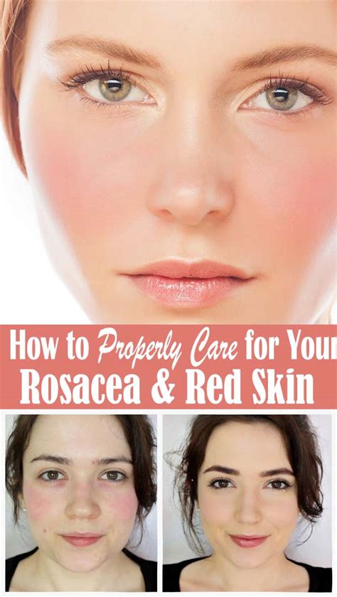 How To Properly Care For Your Rosacea And Red Skin Healthy Lifestyle