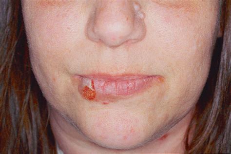 Derm Dx Blisters Blotches And Burning In A 42 Year Old Woman