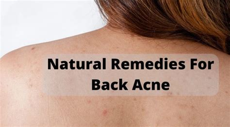 Natural Remedies For Back Acne Archives Go Lifestyle Wiki