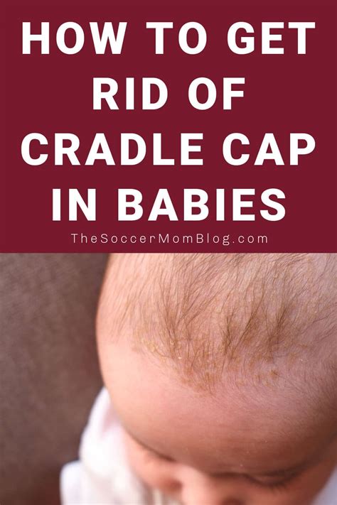 How To Get Rid Of Cradle Cap The Soccer Mom Blog