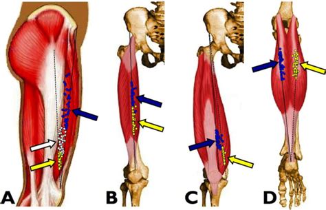 Position of the muscle motor points for the quadriceps and gastrocnemii