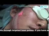 Photos of South Korean Acne Scar Treatment