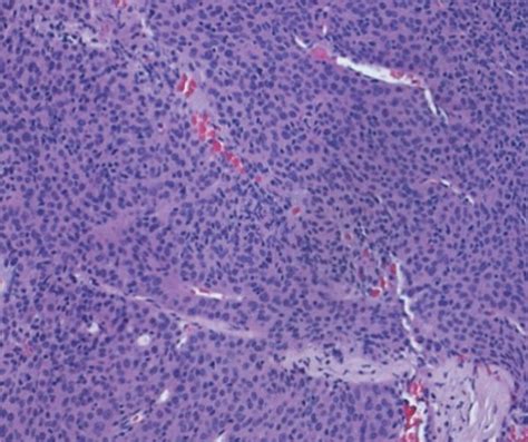 On Histology The Lesional Tissue Is Composed Of A And B Tumour Download Scientific Diagram