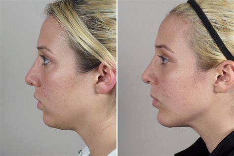 Chin Augmentation New Jersey Parker Center For Plastic Surgery
