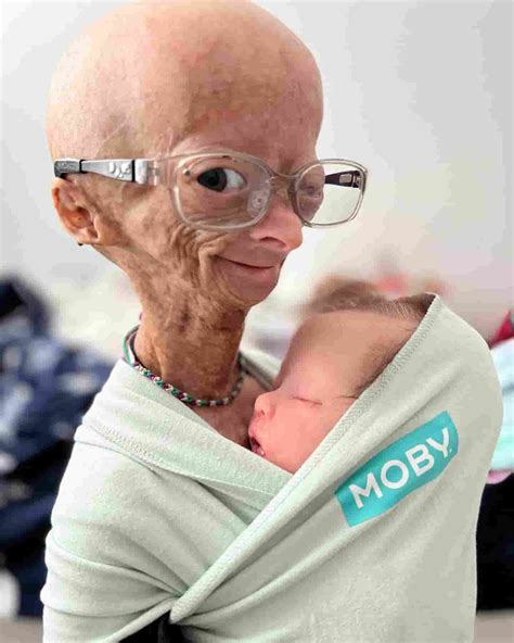 Real Cause Of Adalia Rose Death What Killed Her Sickness And Health