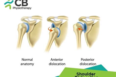 What Is Shoulder Dislocation Symptoms Causes Diagnosis