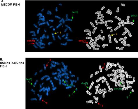 Deciphering The Complexities Of Mecom Rearrangement Driven Chromosomal