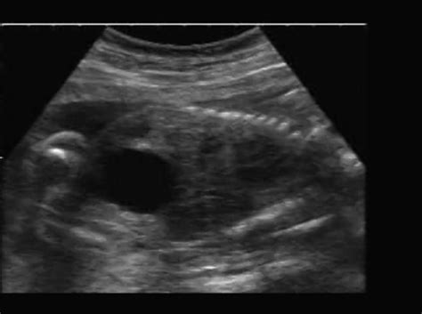 Posterior Urethral Valves Ultrasoundpaedia