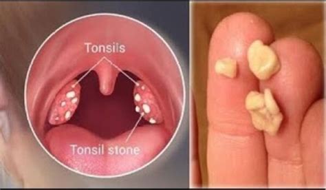 How To Get Rid Of Swollen Tonsils Fast In 24 Hours Right Home Remedies