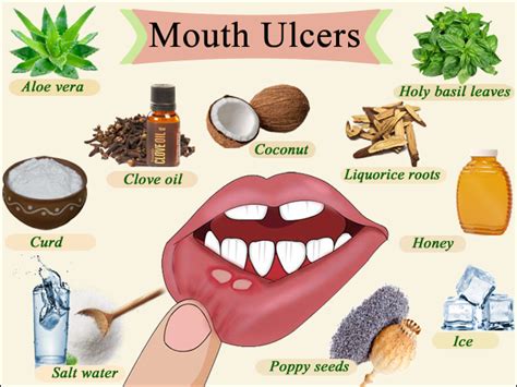 Quick Way To Cure Mouth Ulcer Anna Blog