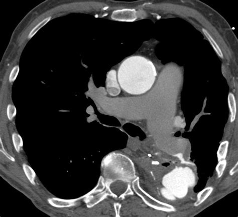 A fistula is a permanent abnormal passageway between two organs in the body or between an organ and the exterior of the body. Aortopulmonary fistula - wikidoc