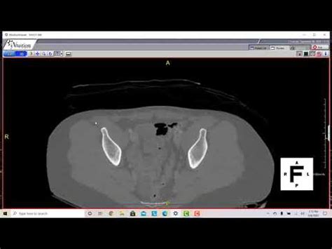 Pelvis CT Anatomy YouTube