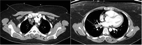 Atypical Presentation Of Sarcoidosis On 18f Fdg Petct Journal Of