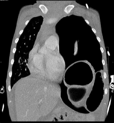 Mikheev a.v., аftаevа e.v., kаzаkovа s.s., zinovievа z.v., gаvrikovа i.n. Thoracic CT scan on admission. Left-sided tension ...