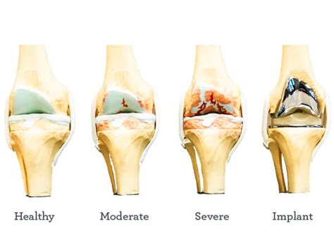 How Much Pain Comes With A Knee Replacement Orthonebraska
