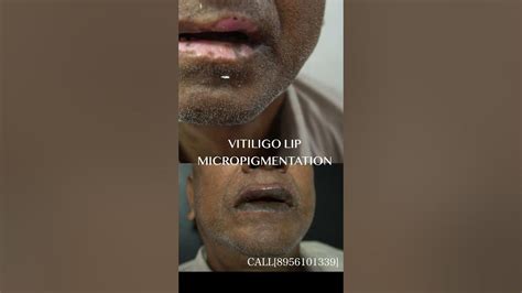 Lip Micropigmentation Lip Vitiligo Treatment Lip Vitiligo Tattoo