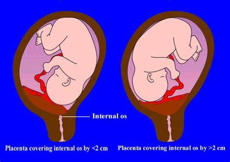classification of placenta previa
