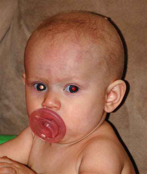 Photored Know The Glow And Check For Normal Red Eye Reflex In Children