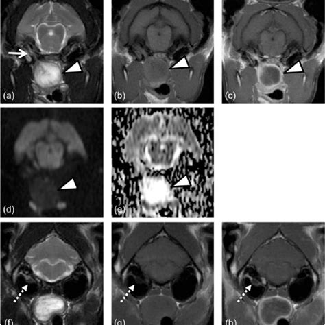 Mri Findings Of A E A Nasopharyngeal Lymphoma In Case 3 F No