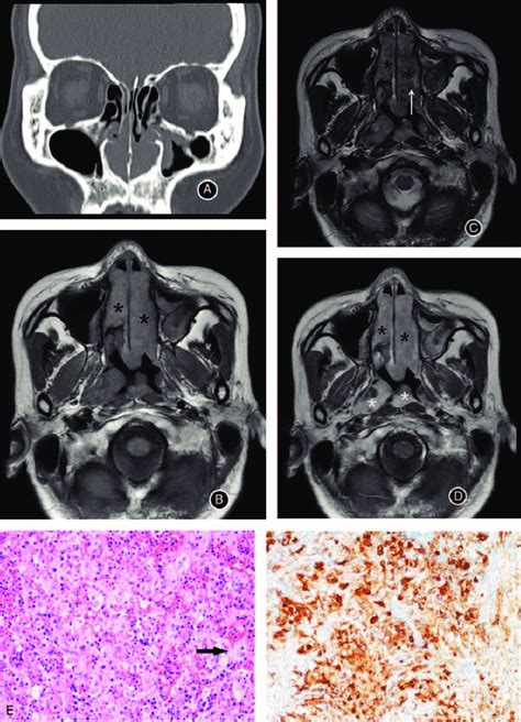 Rosai Dorfman Disease Rdd In A 48 Year Old Woman With Nasal