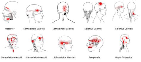 Trigger Point Referral Patterns Headaches Maynard Acupuncture