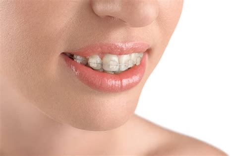 Everything You Need To Know About Braces Istanbul Dental Care