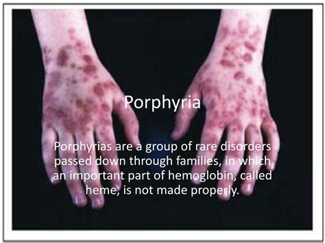 Ppt Porphyria Powerpoint Presentation Free Download Id2240251