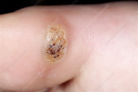 Wart On The Big Toe Stock Image C0142814 Science Photo Library