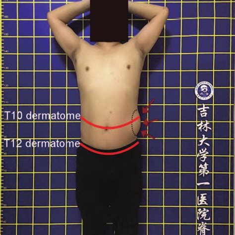 Abdominal Wall Protrusion Appeared Between T10 Dermatome And T12