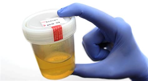 New Urine Test For Malaria