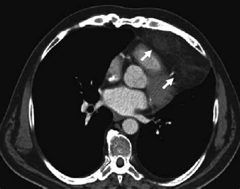 Thymic Lipoma A 59 Year Old Men Is Known With A Spinocellular