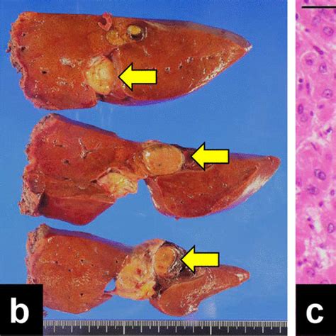Findings Of Initial Liver Resection A Contrast Enhanced Abdominal Ct