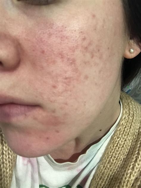 Acne Never Had Open Or Closed Comedones Before But Both Have Started