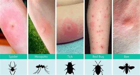 Identify Bug Bites On Humans