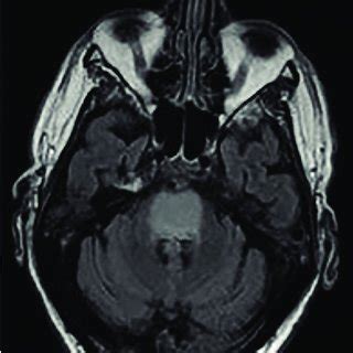 Pdf Central Pontine Myelinolysis Case Report And Short Overview