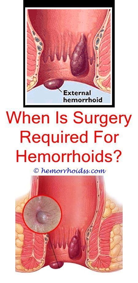 Skin tags, the aesthetic and cosmetic concern, that has sent several of us in a downward spiral. How To Use Hemorrhoid Cream To Tighten Skin? how do you treat external hemorrhoids?.Do ...