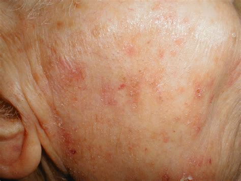 Actinic Keratosis Pictures Causes Symptoms And Treatment