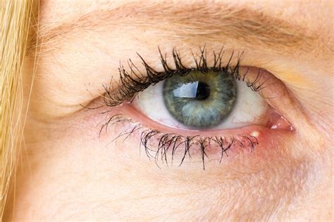 Gradówka na oku i powiece przyczyny leczenie usuwanie domowe sposoby drmax pl