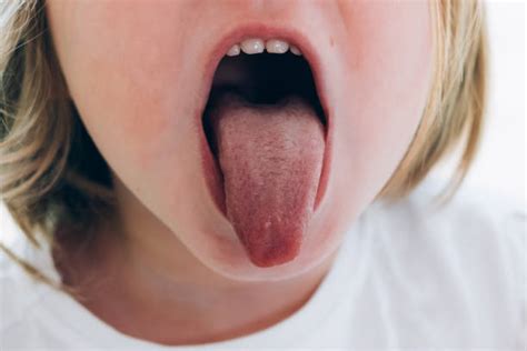 Bumps On The Back Of The Tongue Causes Treatment