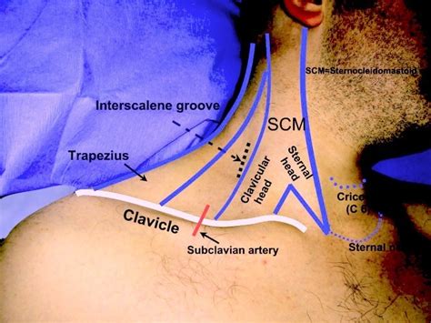 Combined Interscalene Brachial Plexus And Superficial Cervical Plexus