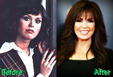 Marie Osmond Before And After Surgery Procedure