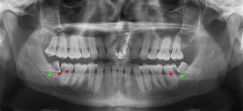 A wisdom tooth is one of the last set of teeth that grows in humans, which typically sprouts between. Wisdom Teeth 101: Impacted Wisdom Teeth Surgery