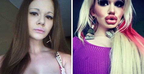 la transformación de una joven de 22 años que se somete a 15 cirugías para agrandar sus labios