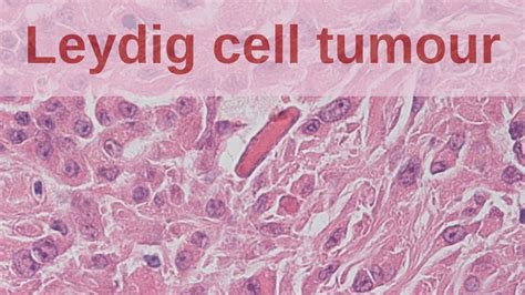 Leydig Cell Tumours Of The Testis Pathology Mini Tutorial YouTube